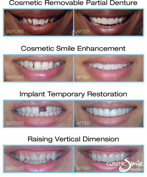 Snap on smile teeth cover