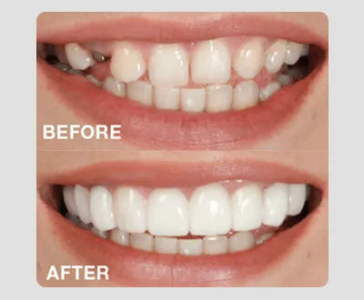 Snap on smile teeth cover